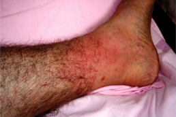 Erisipela
