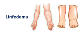 Linfedema