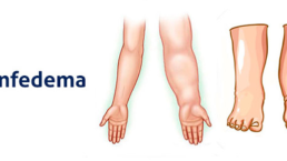 Linfedema