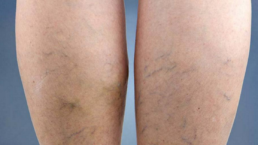 Vasculite